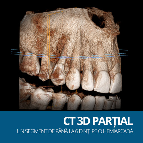 CT 3D PARTIAL