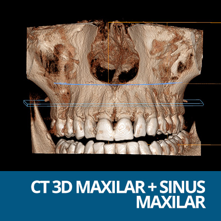 tomografie maxilar sinus maxilar
