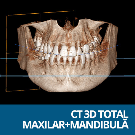 tomografie totala maxilar
