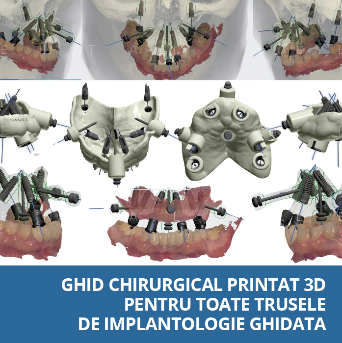 ghid chirurgical printat 3d pentru truse implantologie ghidata
